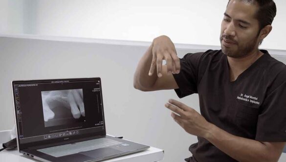La importancia de los implantes dentales para mejorar la calidad de vida de los adultos mayores